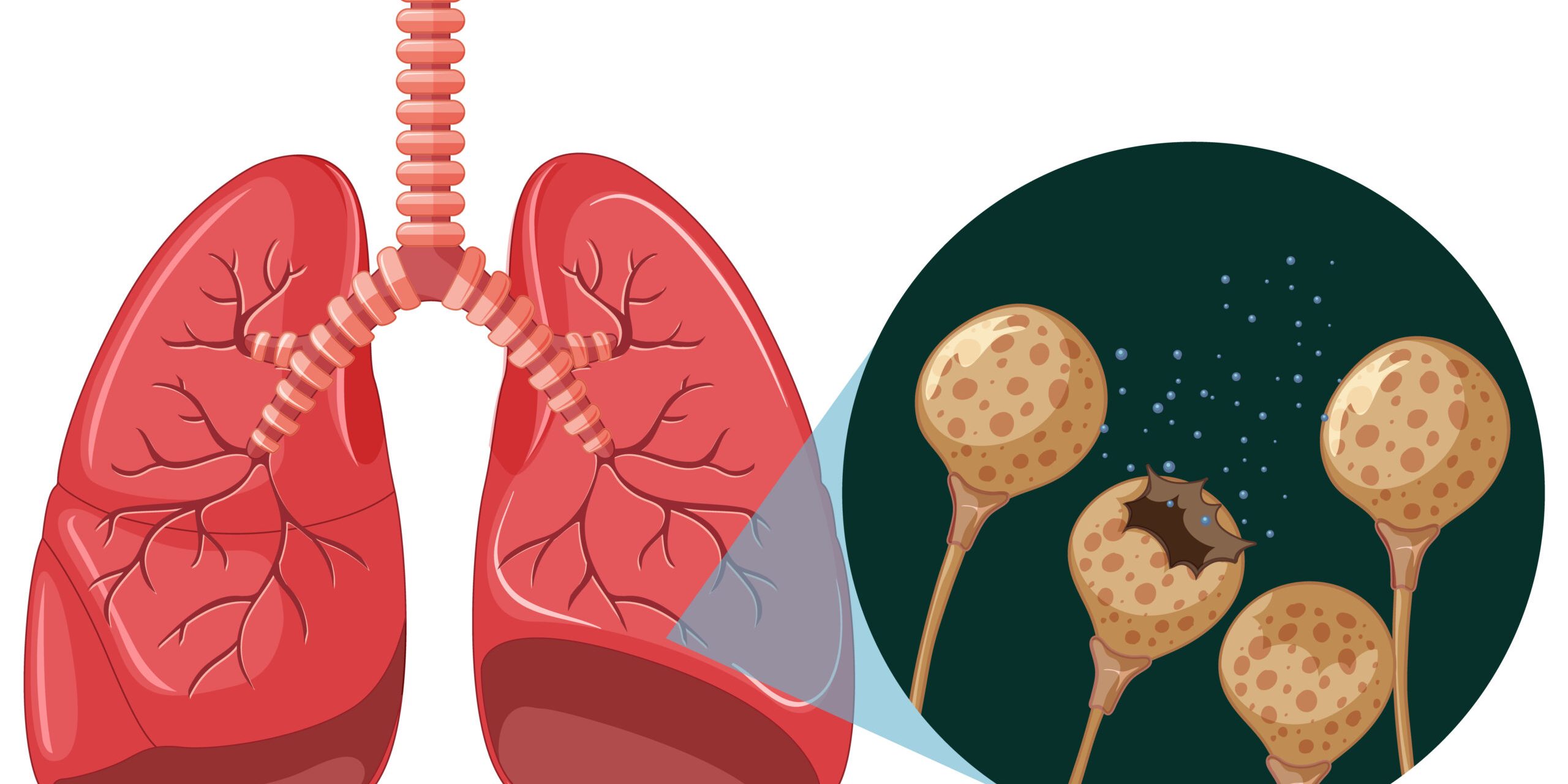 The mold spores grow in human lungs illustration